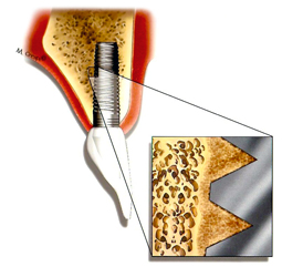 Osteointegrazione impianti dentali dentistici odontoiatrici